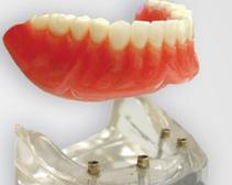 prothèse amovible sur implants removable denture on implants Brossard-Laprairie