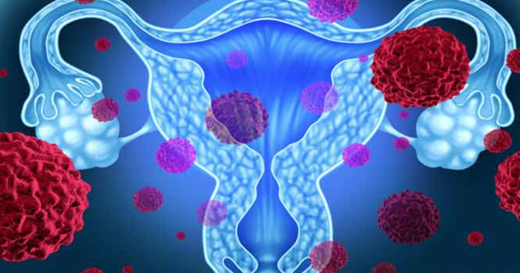 Uterine Cancer - Dr. Joel Wallach