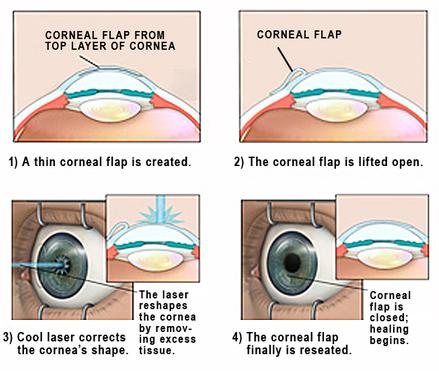 Lasik Laser Eye Surgery