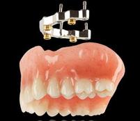 Denture On Implants With Bar Brossard-Laprairie