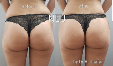 Brazilian butt lift before and after photos