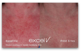 Cosmetic Injectables Center, Encino, Sherman Oaks Botox, Fillers, Restylane, Juvaderm, laser genesis, skin, pigmentation, redness, tightening, wrinkles