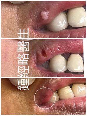 a series of 3 pictures showing the procedure of removing lip lesion with laser