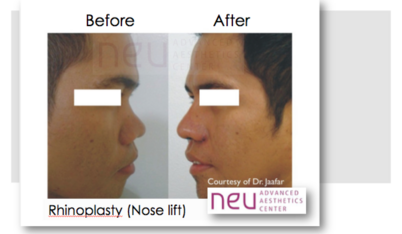 Top Rhinoplasty clinic Philippines Neu Advanced Aesthetics Centre