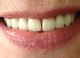 Patients Clinique Implantologie Dentaire Dental Implants Brossard-Laprairie