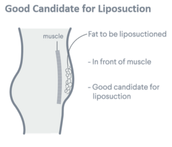 Liposuction Philippines