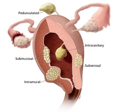 uterus fibroids