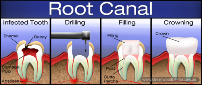 Root Canal Cody WY