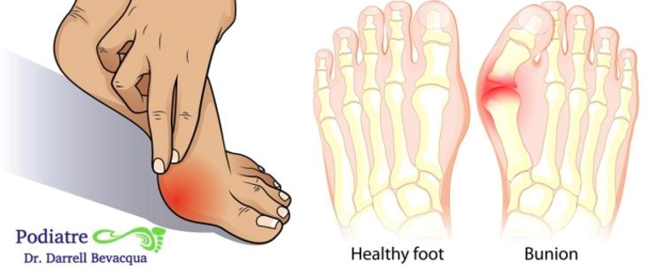 Bunion surgery recovery week by week