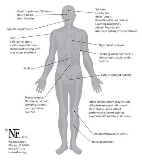 NF1 Research