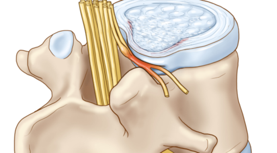 Herniated Disk - Dr. Joel Wallach