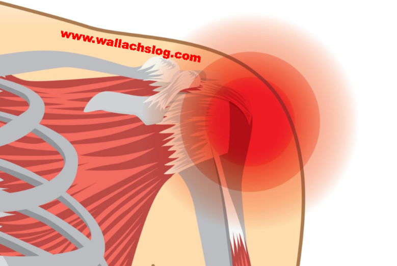 Torn Rotator Cuff - Dr. Joel Wallach