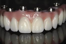 Fixed Denture Fix-On-Zircon Brossard-Laprairie