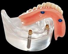 Prothèse Dentaire Sur Implants Michel Puertas Denturologiste Brossard-Laprairie, Denture On Implants Michel Puertas Denturologiste Brossard-Laprairie