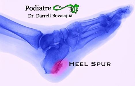 Signs Your Heel Pain Is From A Heel Spur – Perform Podiatry