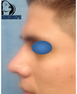 Rinoplastia después