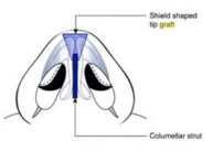 Cartilage rhinoplasty