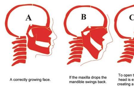 Improve Facial Structure with Correct Tongue Posture