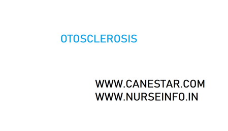 OTOSCLEROSIS – Causes and Risk Factors, Classification, Pathophysiology, Clinical Manifestations and Diagnostic Evaluations