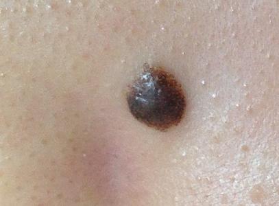 the appearance of a black skin mole on the nose