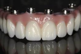 Fixed Denture Fix-On-Zircon Brossard-Laprairie