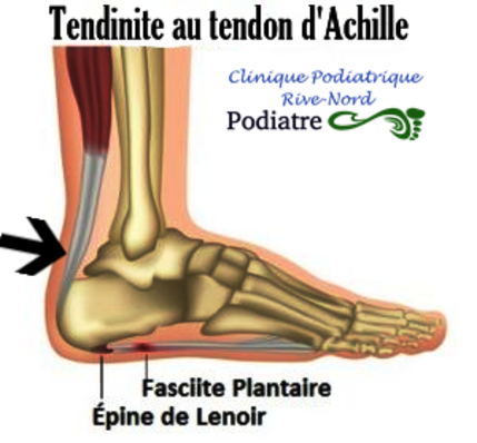 Verrue plantaire  Clinique podiatrique Montréal