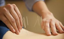 Photo of hands inserting acupuncture needles into human body