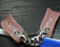 prothèse partielle sur implants Brossard-Laprairie,partial denture on implants Brossard-Laprairie