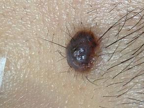 a dark brown skin mole with coarse dark hairs locates under the medial end of the left eyebrow