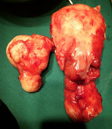 laparoscopic hysterectomy goa