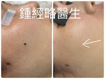 Comparison photo showing mole removal from the right side of the face