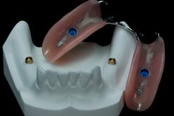 PARTIAL DENTURE ON IMPLANTS "CLICK" Michel Puertas Denturologiste Brossard-Laprairie