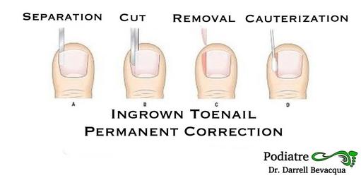 Ingrown Toenail Correction: Podiatrist 25 Years Experience