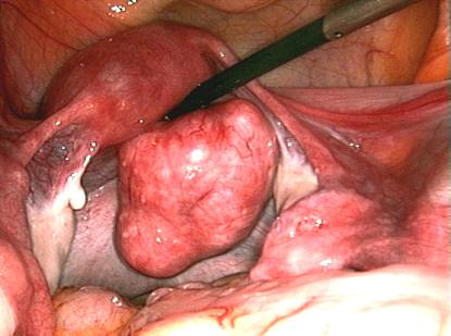 fibroid hysterectomy goa