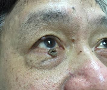 skin wart on lower eyelid margin (eyeline)