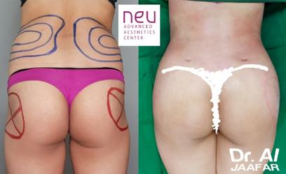 Brazilian Butt Lift  BBL Before and After Photos