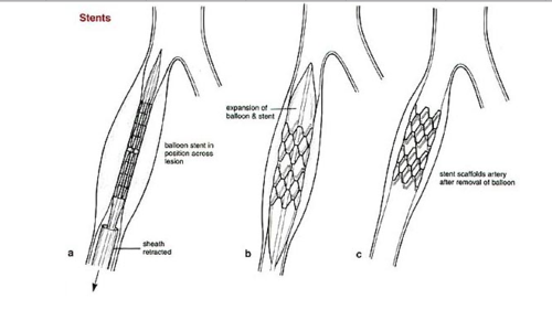 Plugged Arteries - Dr. Joel Wallach