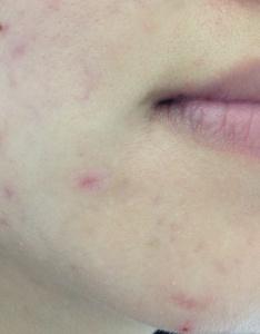 傷口近鏡：術後２個月，疤痕呈淺紅色，幾乎沒有凹陷