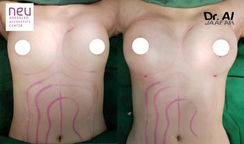 Breast fat grafting transfer Philippines before and after photos