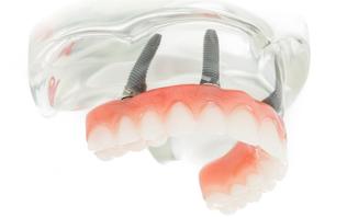 Fixed Denture On Implants Michel Puertas Denturologiste Brossard-Laprairie