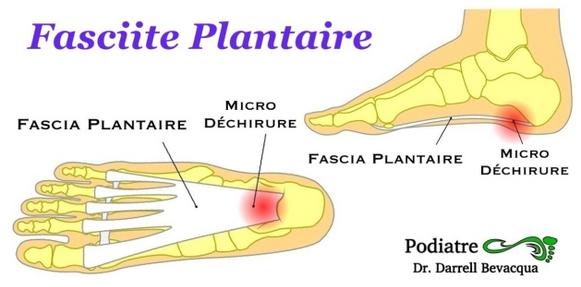 Fasciite plantaire pine de Lenoir. Solutions sans douleur