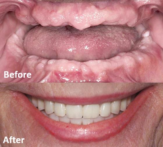 AFFORDABLE Dental Implants For Seniors LOW COST//BEST PRICE