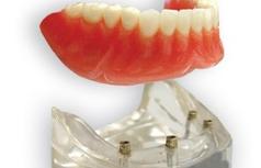 prothèse amovible sur implants Brossard-Laprairie, removable denture on implants Brossard-Laprairie