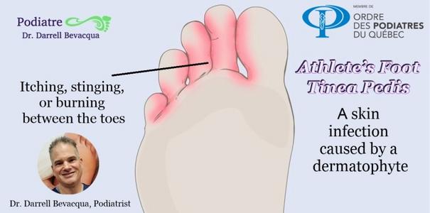 Athletes foot (Tinea pedis) Consult us for all fungal problems of