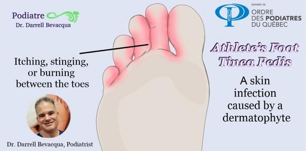 What is Tinea Pedis: Symptom and Treatment