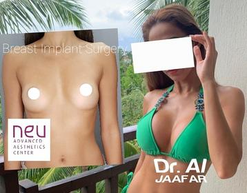 Breast implants before and after photos