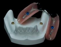 Prothèse Partielle Sur Implants Clinique Implantologie Dentaire