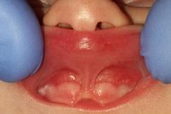 Gap in newborn clearance gums