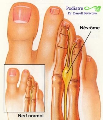 Foot Surgery: Neuroma or Plantar Callus