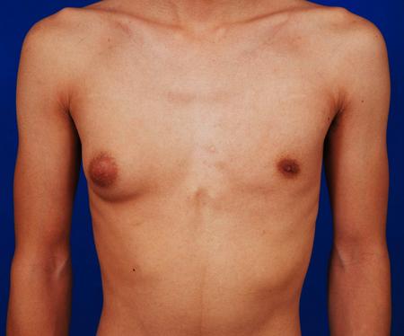 GYNECOMASTIA - Causes and Risk Factors, Clinical Manifestations, Diagnostic Evaluations and Management